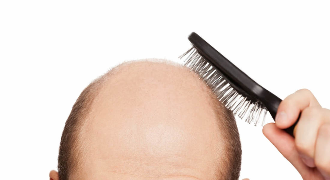 Causes And Signs Of Baldness In Men Hair Loss Tips